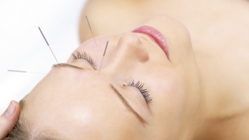 Acupuncture et LAMal