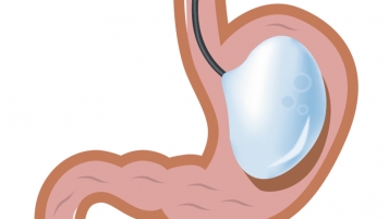 Les risques des ballons gastriques